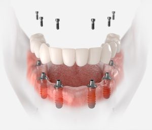 Alt Çene İmplant Uygulaması