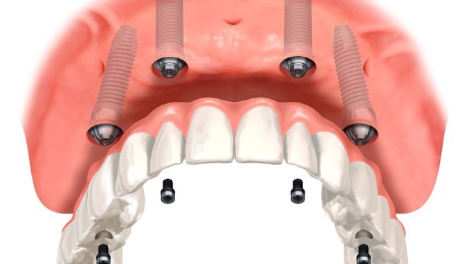 Üst çene implant