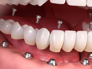 Bütün dişlere implant