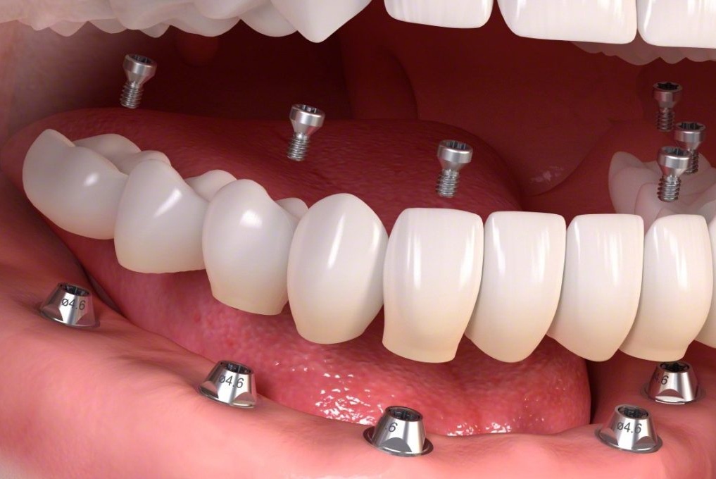 Bütün dişlere implant
