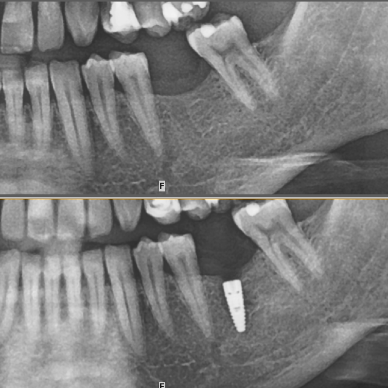 tek diş eksikliğinde implant